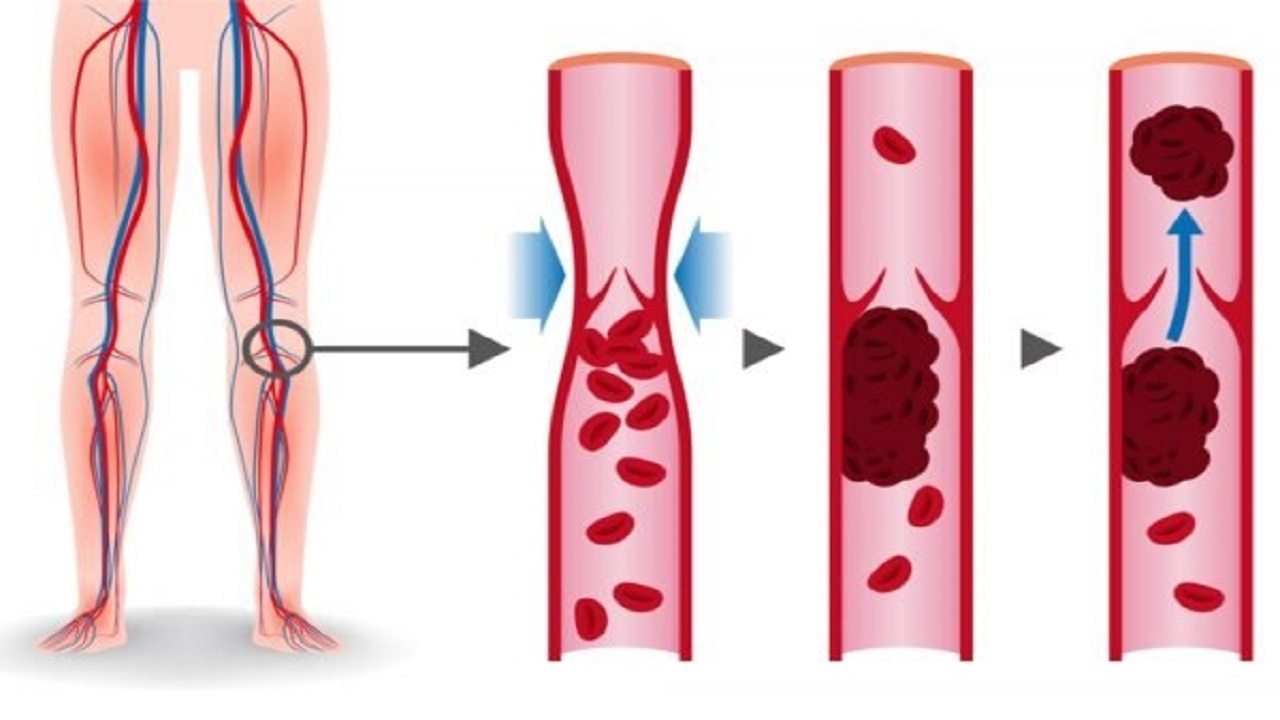 خطرات لخته خون در پا، علائم و راه‌های پیشگیری