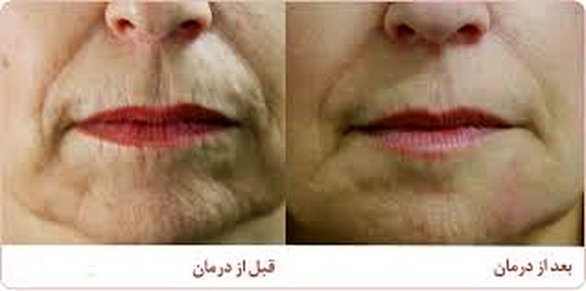 روش‌های جلوگیری از چروک لب
