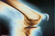 یک راه برای پیشگیری از پوکی استخوان