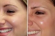 چگونه چین و چروک دور چشم را برطرف کنیم؟