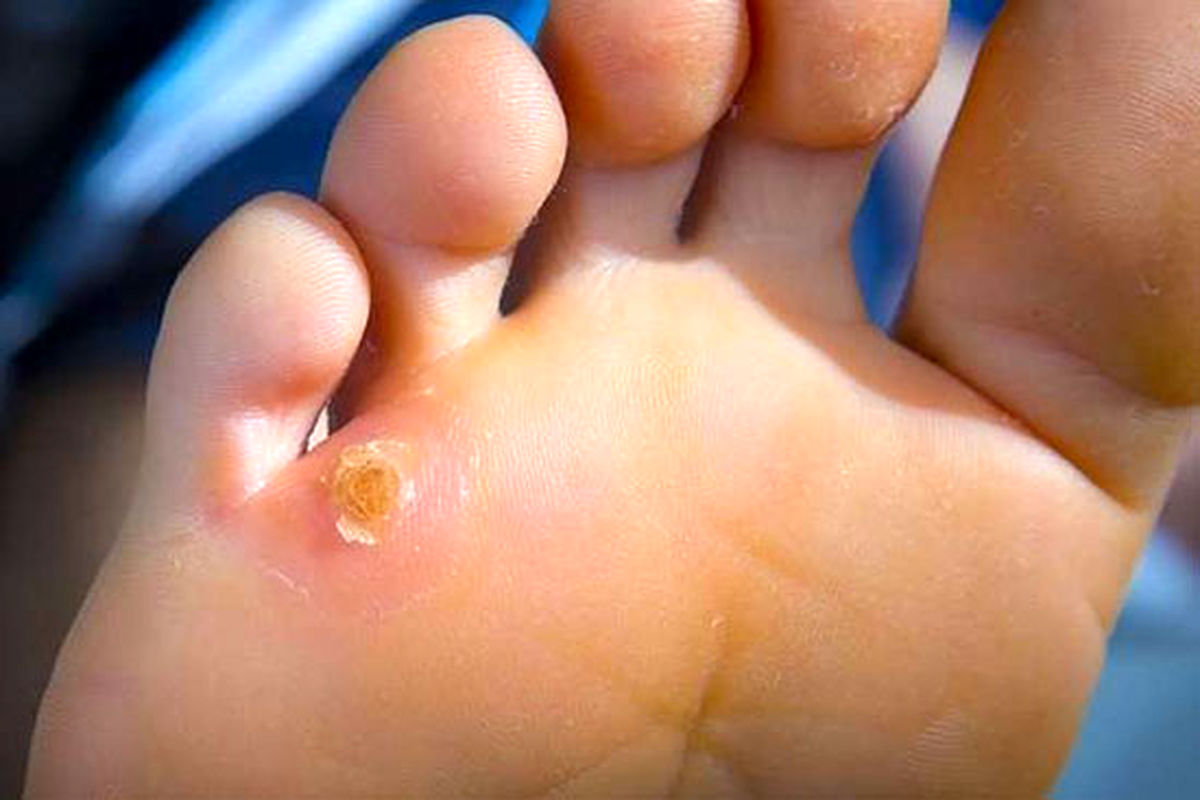 نسخه طب سنتی برای درمان میخچه و پینه