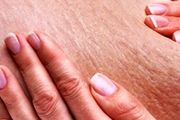 سلولیت در کمین چه کسانی است؟ راه درمان