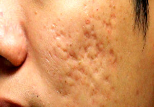 راه‌های طلایی برای درمان آکنه