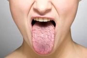 خشکی دهان چیست؟