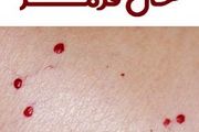 از خال‌های قرمز پوست بترسیم یا نه؟