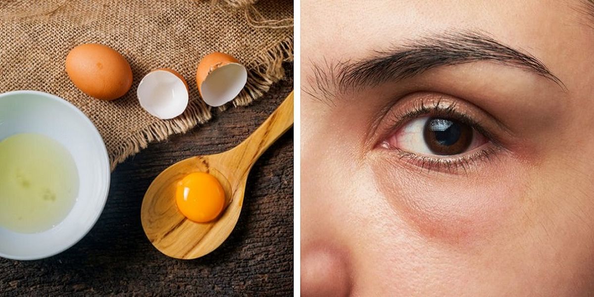 راهکار‌های ساده برای از بین بردن پف زیر چشم