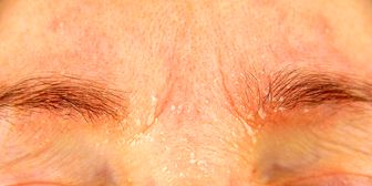 شوره ابرو چیست؟ + درمان