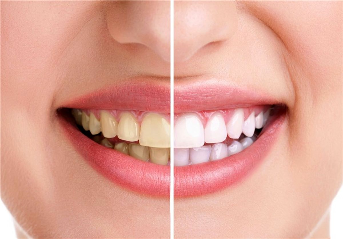 چگونه دندانی سالم و سفید داشته باشیم؟