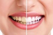 پیشگیری از پوسیدگی دندان در مناطق محروم/ عکس