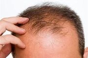 
باکتری‌ها چه نقشی در ریزش موی سر دارند؟

