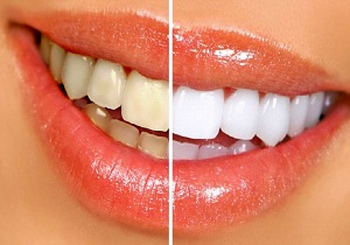 چگونه دندان‌های سالمی داشته باشیم؟
