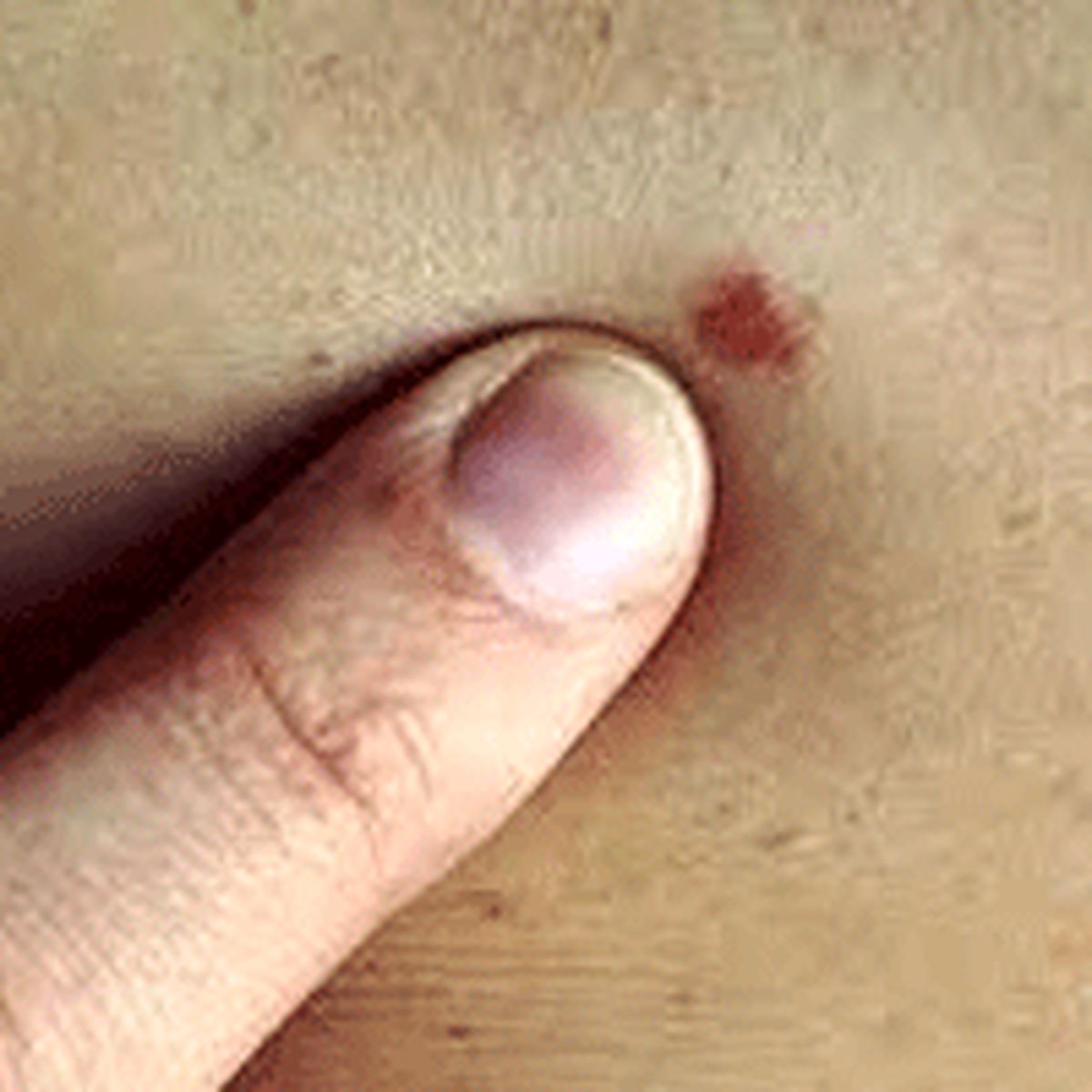 آیا خال را باید به تیغ جراحی سپرد؟