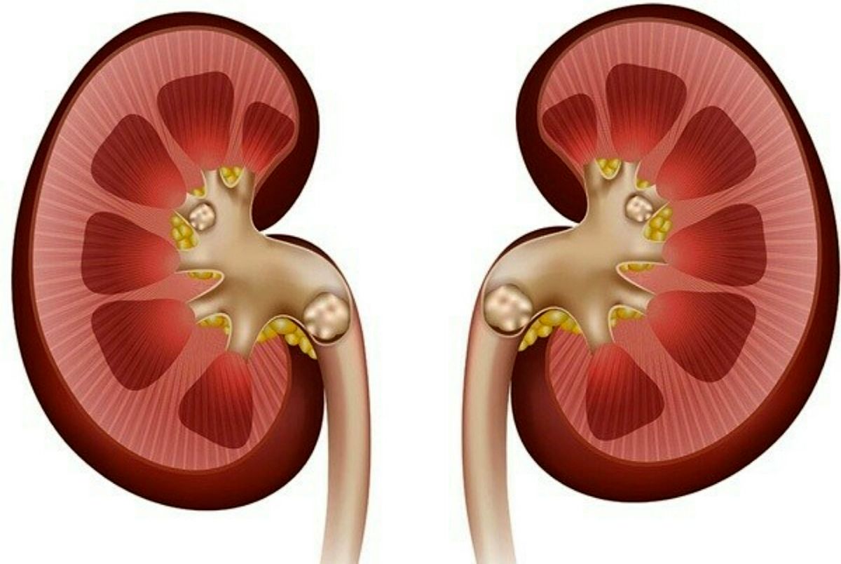 با مصرف این نوشیدنی از سنگ کلیه فرار کنید
