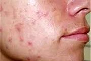حجامت برای افراد لاغر و کم‌خون مضر است