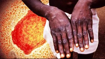 مورد مشکوکی از ابتلا به آبله میمونی در کشور مشاهده نشده است
