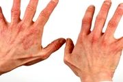 علل و راه‌های درمان بیماری پسوریازیس
