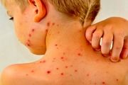 واکسیناسیون تمام کودکان زیر ۵ سال برای مقابله با سرخک ضرورت ندارد
