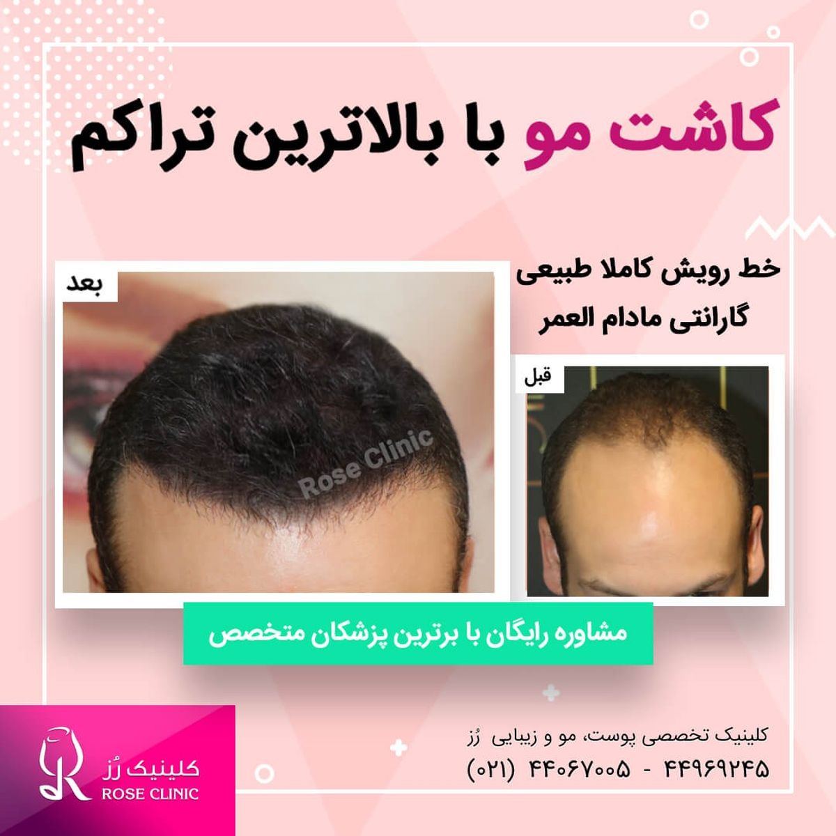 سن مناسب کاشت مو چقدر است ؟

