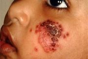 سالک روستایی یک بیماری بومی در مناطق گرمسیری کرمانشاه است