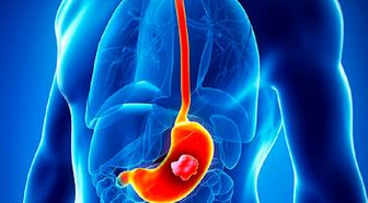 سرطان‌های دستگاه گوارش قابل پیشگیری هستند
