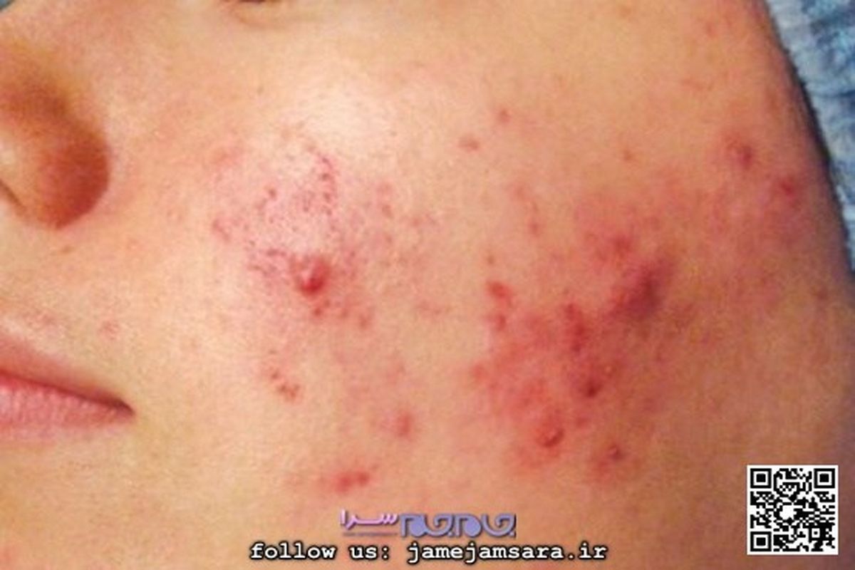 کدام آکنه سراغ تان آمده و چگونه درمان می شود؟+تصاویر