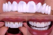 لمینت متحرک دندان چیست؟