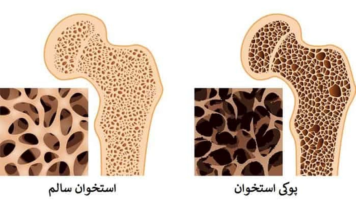 برای جلوگیری از پوکی استخوان چه چیزهایی بخوریم؟