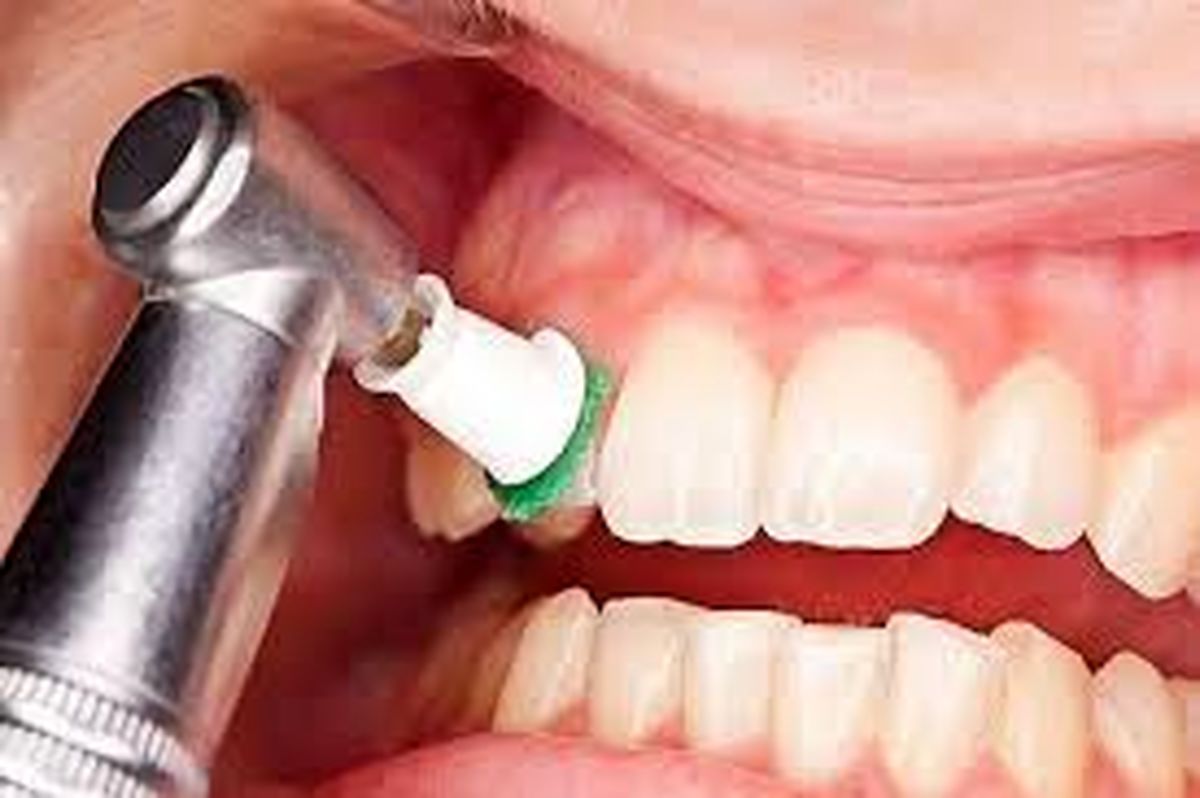 آیا جرم‌گیری به مینای دندان آسیب می‌زند؟