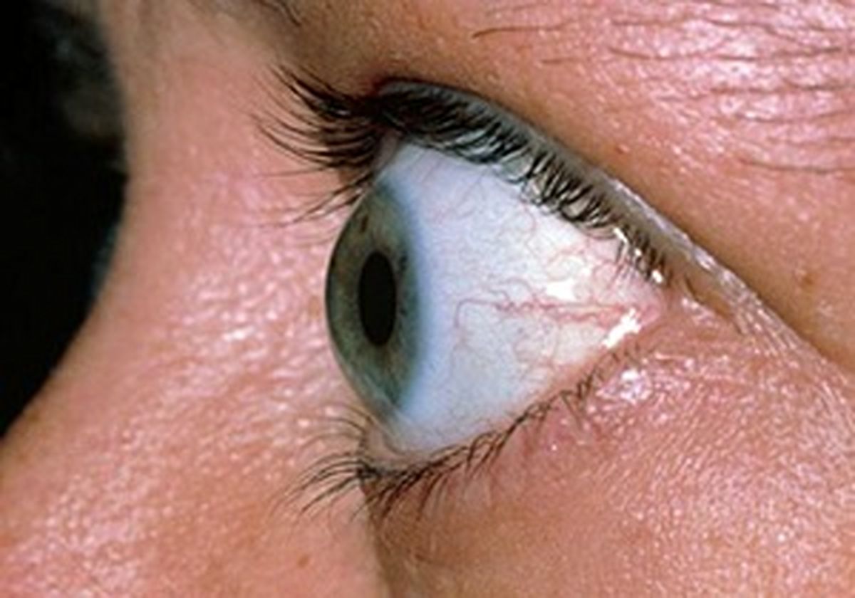 چرا چشم‌ها از حدقه بیرون می‌زند؟