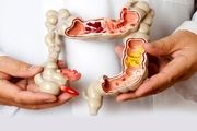 علائم سندروم روده تحریک پذیر چیست؟
