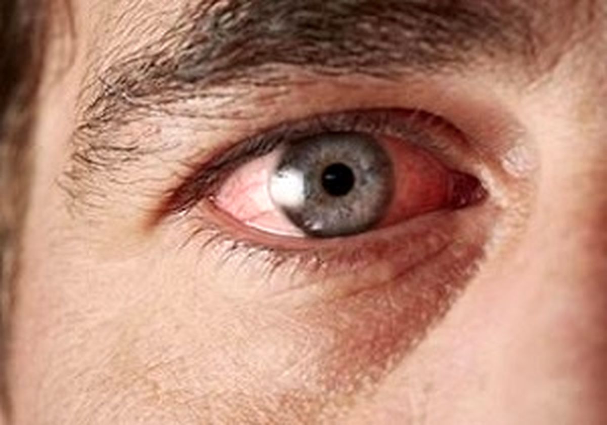 اگر در بهار دچار قرمزی چشم می‌شوید این خوراکی‌ها را نخورید