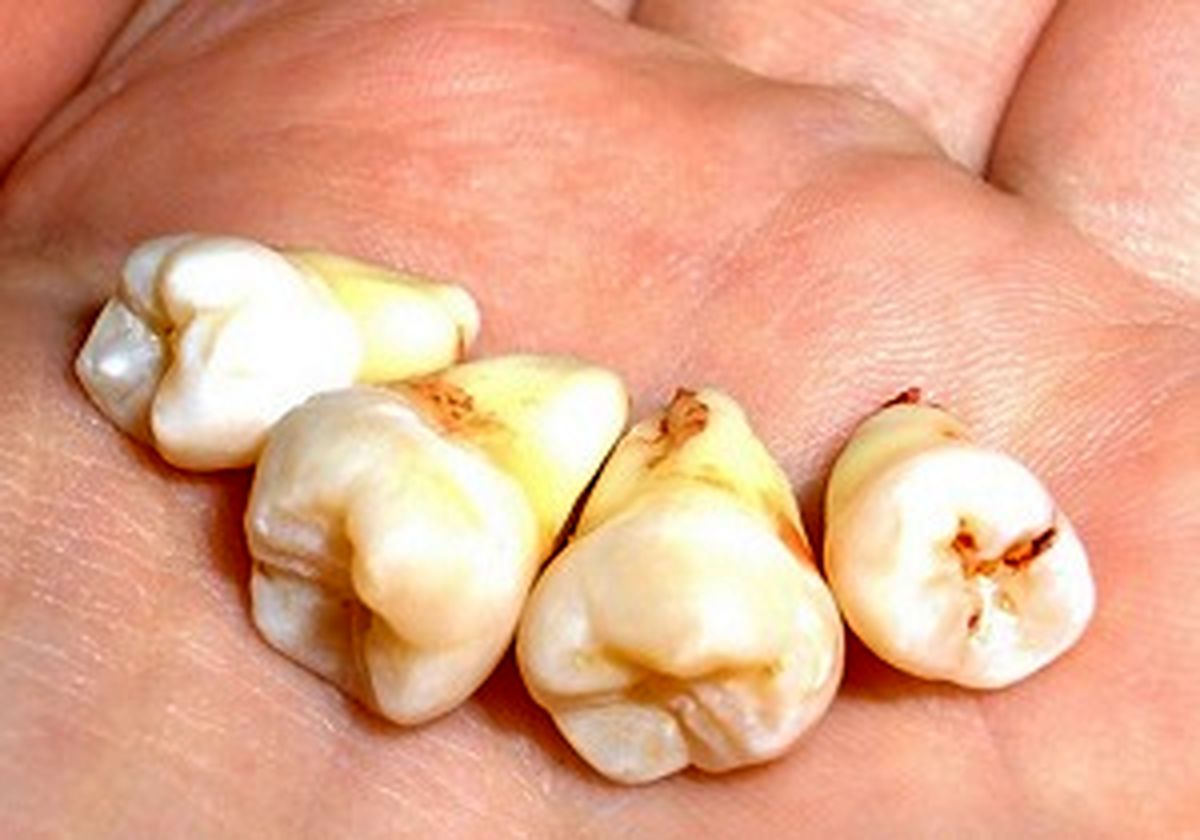  برای جراحی دندان عقل چه زملنی اقدام کنیم؟